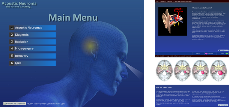 Acoustic Neuroma